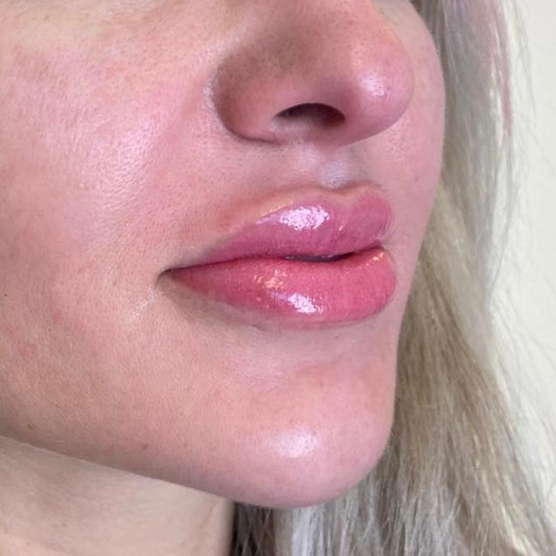 After lip blushing at Bella Via Medical Spa.